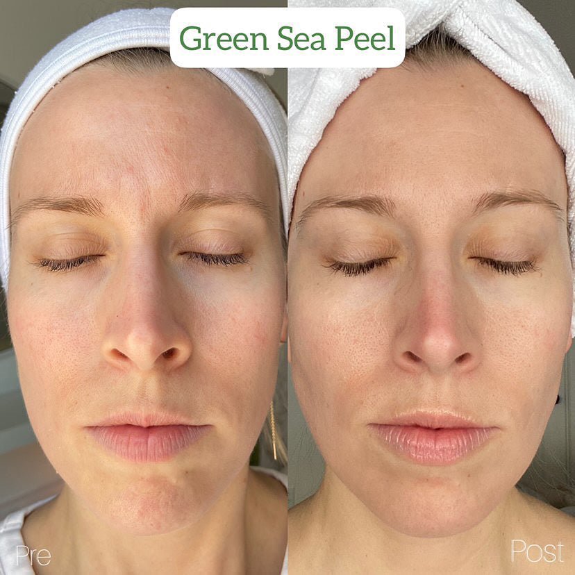 KrX Aesthetics Green Sea Peel Got An Upgrade - by Kin Aesthetics