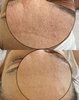 KrX CO2 Carboxy Therapy - by Kin Aesthetics