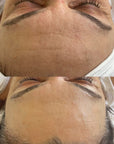KrX CO2 Carboxy Therapy - by Kin Aesthetics