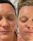 KrX CO2 Carboxy Therapy - by Kin Aesthetics