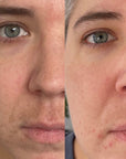 KrX Lazer Peel - by Kin Aesthetics