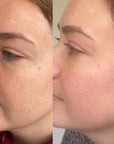KrX Lazer Peel - by Kin Aesthetics
