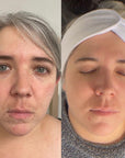 KrX Lazer Peel - by Kin Aesthetics