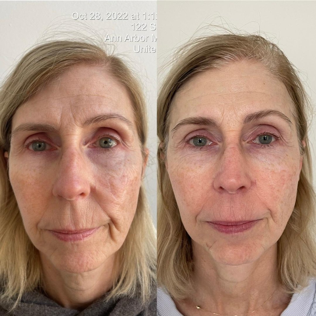 KrX Youthplex Face Lift Toning Solution - by Kin Aesthetics