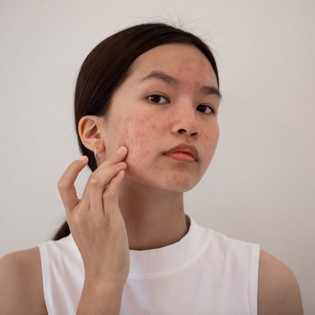 How To Become An Acne Expert - by Kin Aesthetics