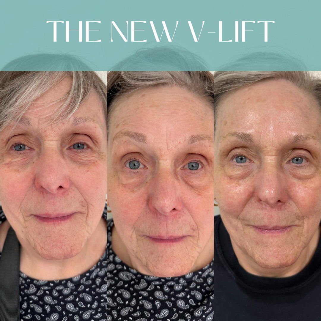 KrX V-Tox Lift Mask - by Kin Aesthetics